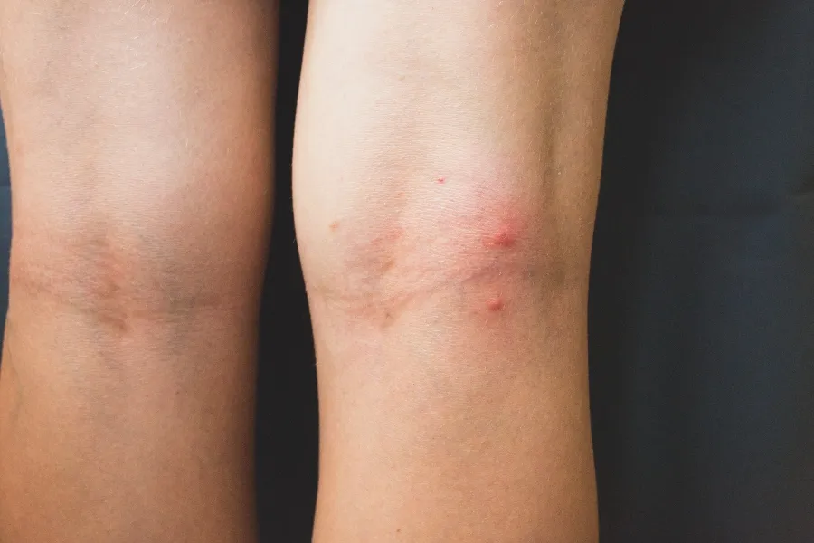 A close-up of the back of a person's legs showing multiple red, swollen bed bug bites on the skin.