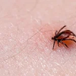 A tick burrowed on a person's hand - keep pests away from your home with Arrow Exterminating Company in NY