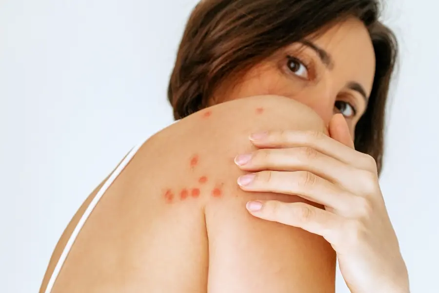 A woman looking over her shoulder to show a cluster of red, raised bed bug bites on her upper back and shoulder.