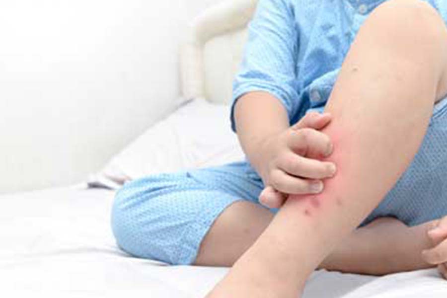 a child scratches bed bug bites on their leg