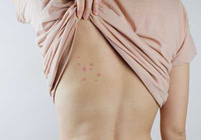 a person with bed bug bites on their back