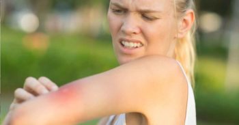 Blonde woman with irritated mosquito bite on arm.