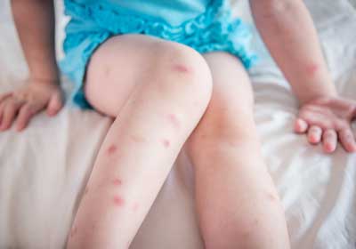 a child with bed bug bites on her skin